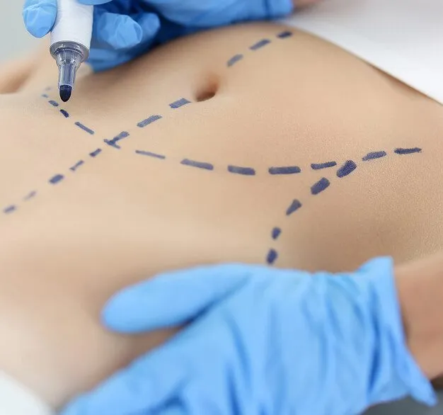 Why choose Vaser Lipo 360