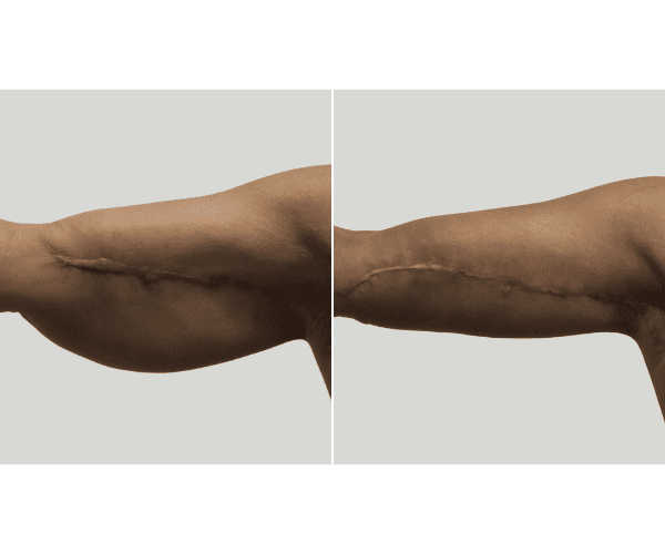 ARM LIFT 1