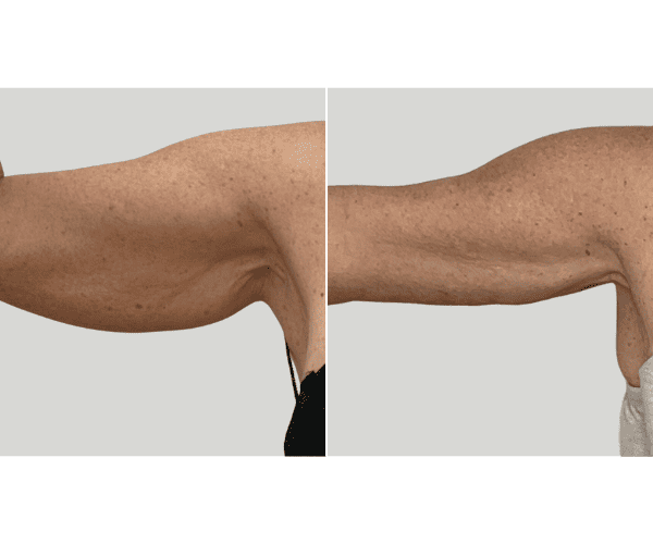 ARM LIFT 2